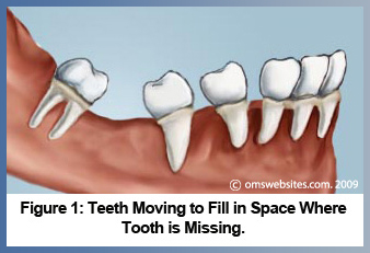 Figure 1: Teeth Moving to Fill in Space Where Tooth is Missing