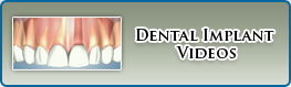 Dental Implant videos
