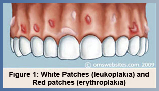 Figure 1 : White Patches (leukoplakia) and red patches (erythroplakia)