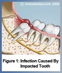 Figure 1 : Infection Caused by Impacted Tooth