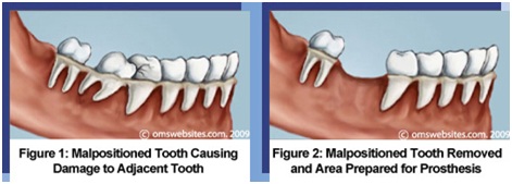 Figure : Dentoalveolar Surgery
