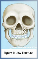 Figure 1: Jaw Fracture