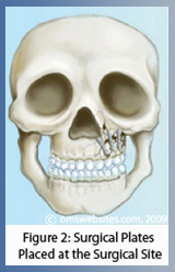 Figure 2: Surgical Plates Placed at the Surgical Site