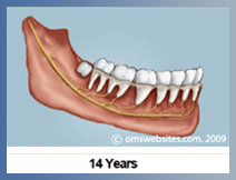 Wisdom Teeth in 14 Years