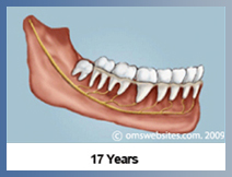 Wisdom Teeth in 17 Years