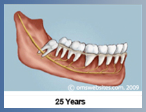 Wisdom Teeth in 25 Years